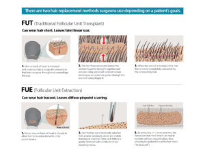 hair transplant method