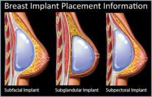 Image of breast implant placement